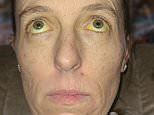 How my skin and eyes turned YELLOW after taking an $8 ‘natural’ menopause supplement