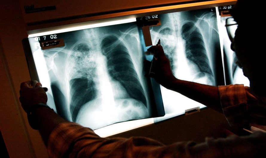 US tuberculosis cases in 2023 were at highest level in a decade, CDC says