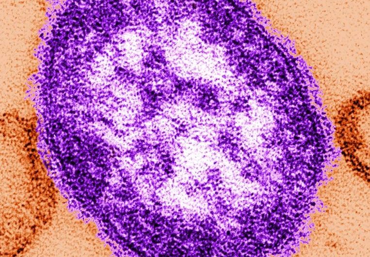 Child under 5 dies after being hospitalized for measles: Public Health Ontario