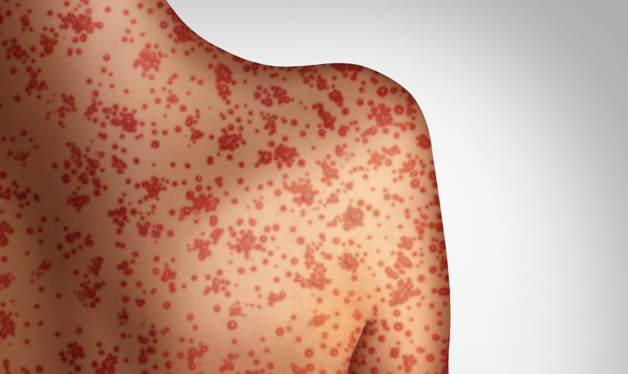 Traveler infected with confirmed case of measles at Seattle International Airport as cases in US increase