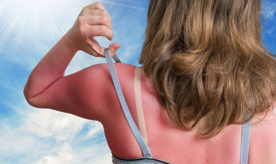 Sunburn SOS: 7 tips to soothe your sun-damaged skin, according to a wellness expert